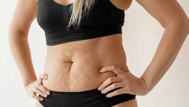 Diastasis Recti: What Is It and Can Physiotherapy Help?